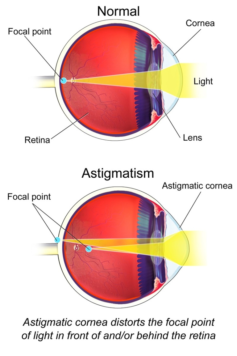 How Long Does It Take To Correct Astigmatism